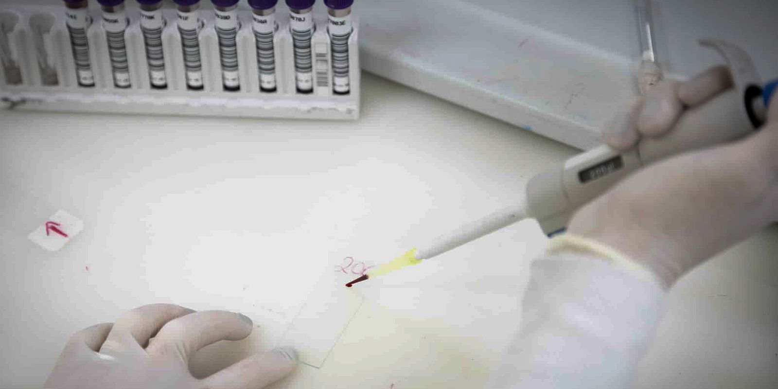 paciente-em-sp-com-suspeita-de-ebola-testa-positivo-para-meningite