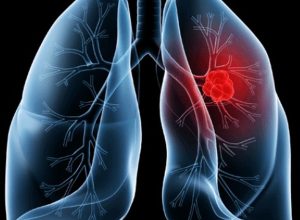 saiba-o-que-e-adenocarcinoma-pulmonar,-cancer-que-atinge-o-papa-leao
